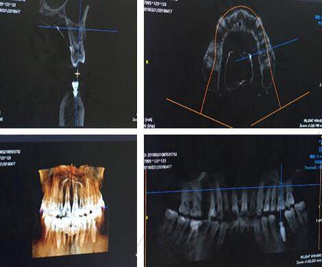 金铂利口腔医院3D数字化种植牙技术很靠谱