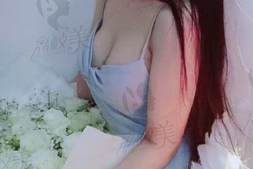 深圳美莱郭杰自体脂肪丰胸术后反馈