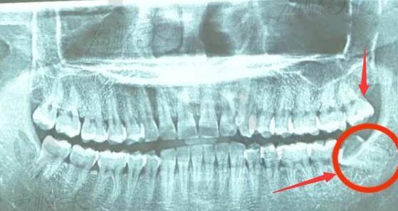 看牙的时候进行拍片确定牙齿位置