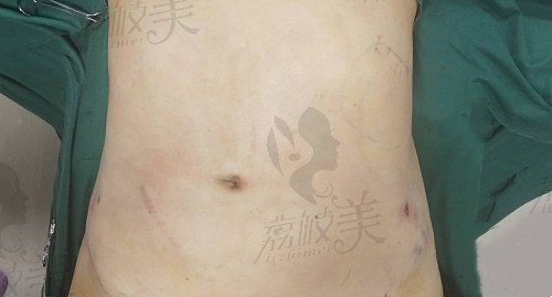 腰腹吸脂术后图