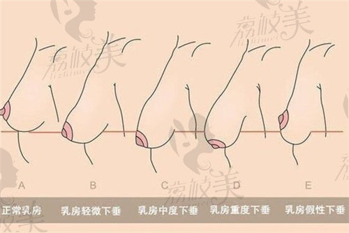 武汉做乳房下垂矫正的医院哪家好？