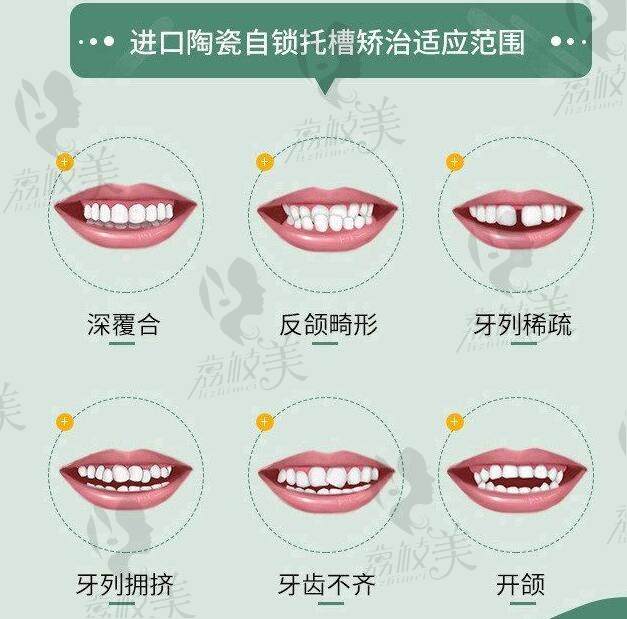 掏槽自锁矫治适应范围