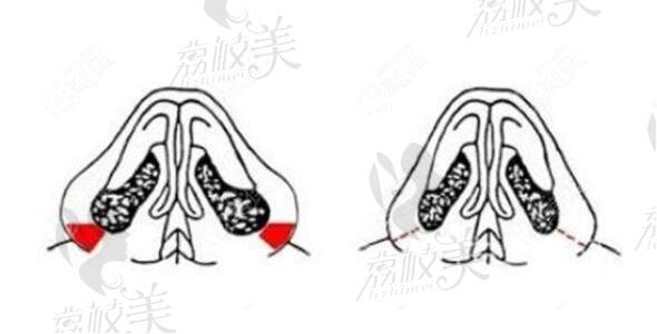 鼻翼縮小手術(shù)對比示意圖