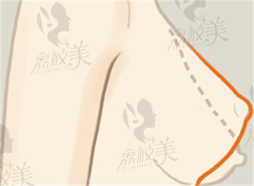 武汉江城整形外科医院胸部修复价格