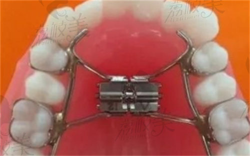 吉大口腔扩弓治疗矫治示意图