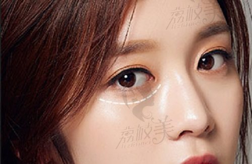 深圳美莱急速祛眼袋技术