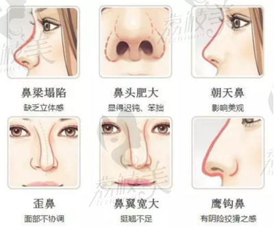 隆鼻技术
