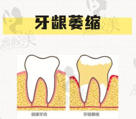 健康牙医和牙龈萎缩的对比