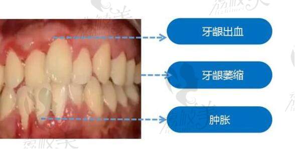 牙龈萎缩的症状