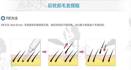 珠海韓妃fue植發(fā)技術(shù)