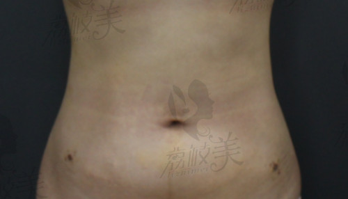 韩国qline女性医院吸脂手术后图