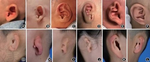 韩国普罗菲耳(profile)小耳再造耳畸形种类
