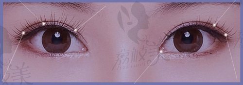 陈磊医生双眼皮的六大维度定制美眼术