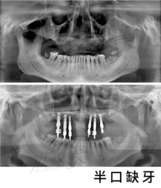 北京优贝口腔半口种植牙