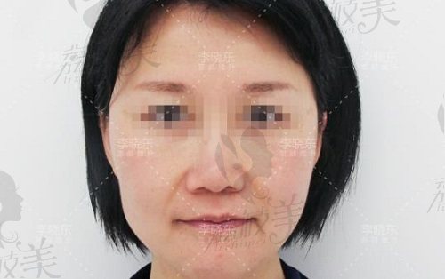 李晓东面部提升术前 李晓东面部提升术前