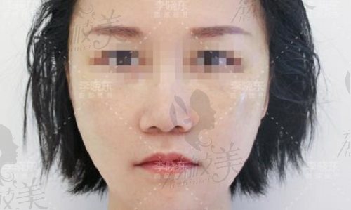 李晓东面部提升术后 李晓东面部提升术后