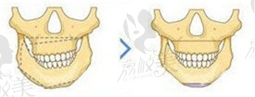 蔣自強(qiáng)做正頜手術(shù)怎么樣？