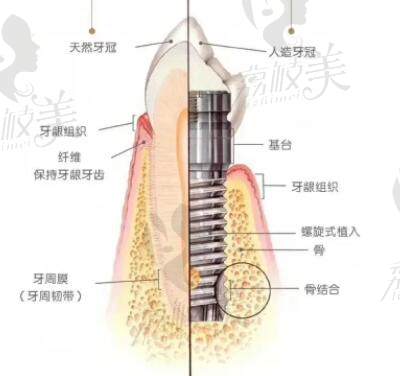 正常牙齿和种植牙的机构区分
