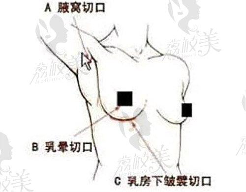 冯辉利医生隆胸手术疤痕浅