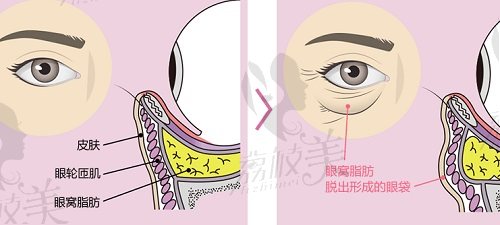 郑州欧华柳燕医生不开刀去眼袋技术怎么样？