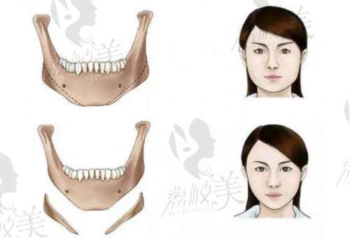 國內(nèi)磨骨手術(shù) 國內(nèi)磨骨手術(shù)