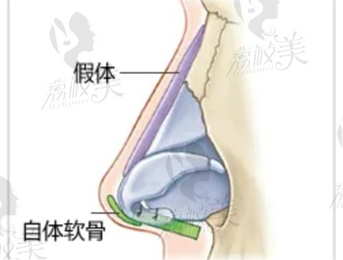 范荣杰医生做鼻修复手术真不错