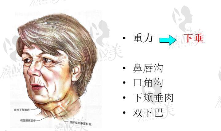 面部衰老会造成多个地方下垂