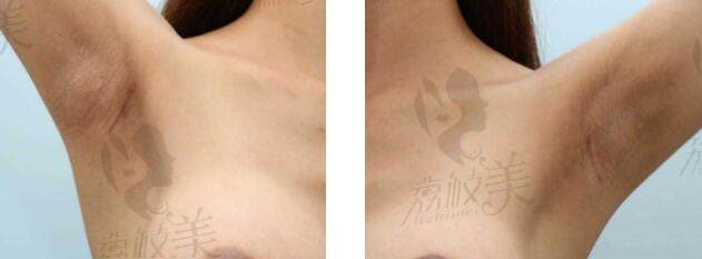 韩国歌柔飞整形外科假体隆胸切口隐蔽