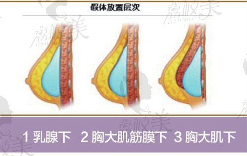 南京美莱夏建军丰胸假体放置位置