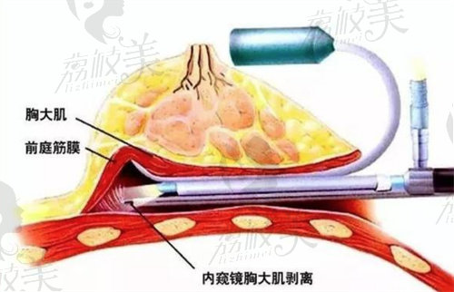 南京美萊夏建軍24小時(shí)極速豐胸