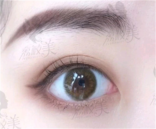 韩国3wishesps整形外科双眼皮评价.jpg
