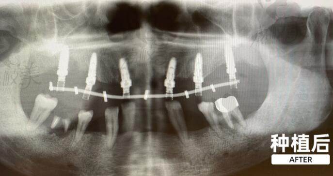 福莱堡德品口腔即刻种植牙技术恢复满口牙
