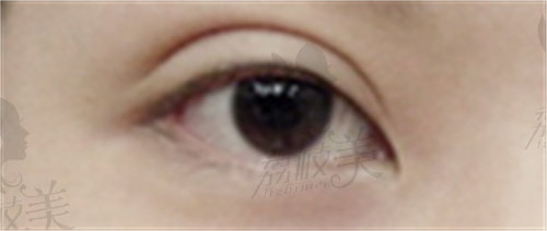 韩国BIO整形外科双眼皮修复评价1.jpg