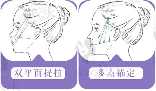 深圳谭永嘉医生微拉美3.0面部提升术