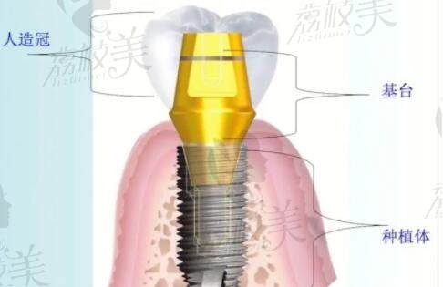 植牙的机构分类