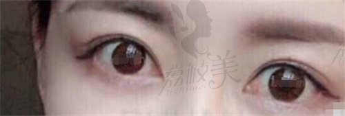 韩国DH枓翰整形外科申枓翰双眼皮修复评价1.jpg