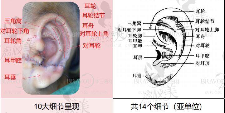 耳在造手术需要塑造的14个细节