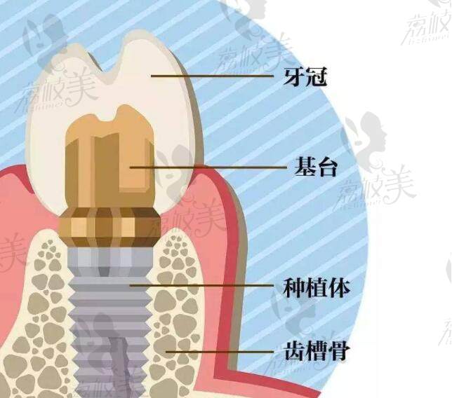 种植牙优势