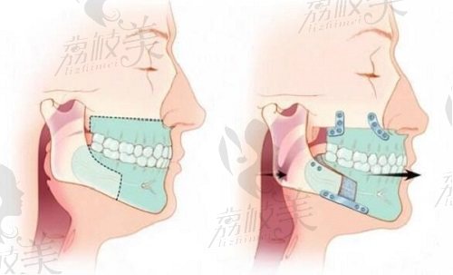 韩国双鄂手术多少钱