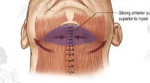 颈阔肌成形术要多少钱