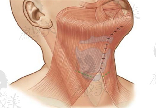颈阔肌成形术做了之后提升明显