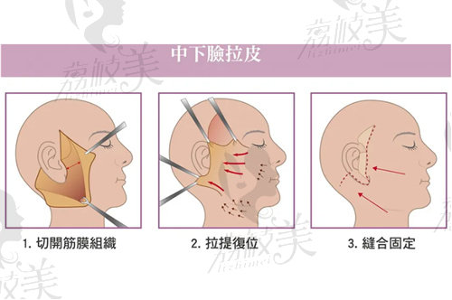 陈兵医生做小切口拉皮技术