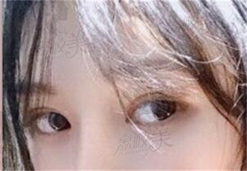 韩国喜可整形外科双眼皮评价1.jpg