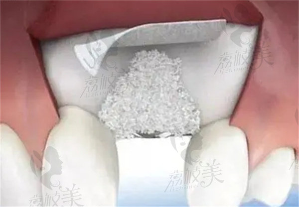 种牙加骨粉骨膜超级疼是真的吗