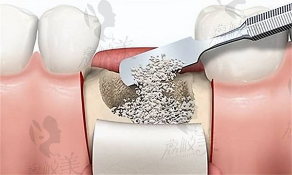 种植牙植入骨粉多少时间可以恢复