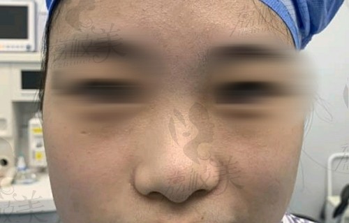 韩国优雅人隆鼻手术前