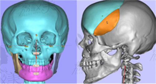 何锦泉医生结合全新3D数字化颌面技术，可以提高手术预见性