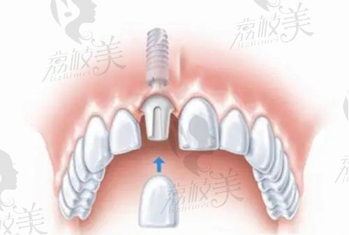 南京美奥口腔医院种植半口牙多少钱？