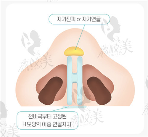 韩国温度整形外科韩俊院长隆鼻技术好