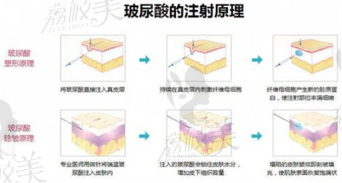 玻尿酸注射原理